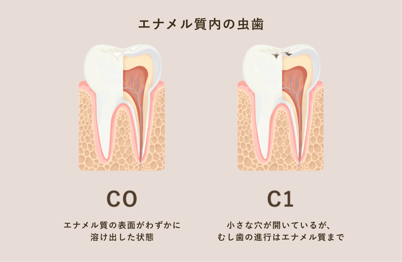 初期の虫歯