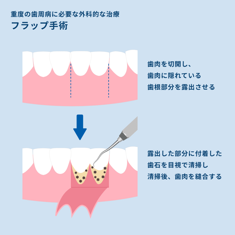 歯周病フラップ手術